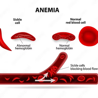 প্রথম জিন থেরাপি অনুমোদন: সিকেল সেল অ্যানিমিয়া নিরাময়